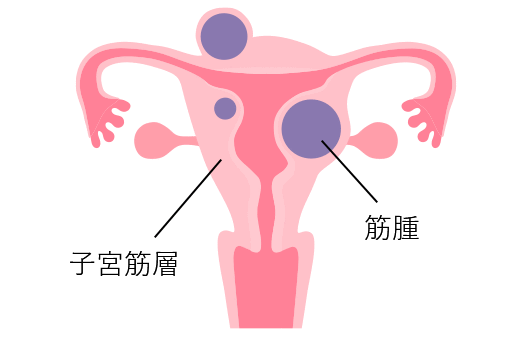 イメージイラスト:子宮筋腫